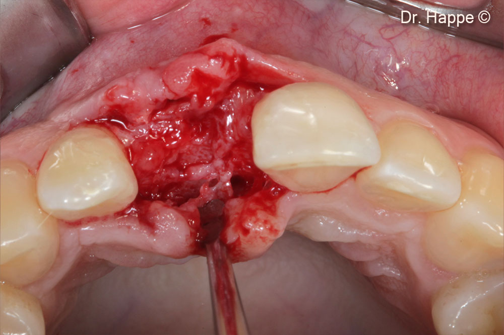 Hình ảnh nhìn từ mặt nhai của sống hàm đã tái tạo