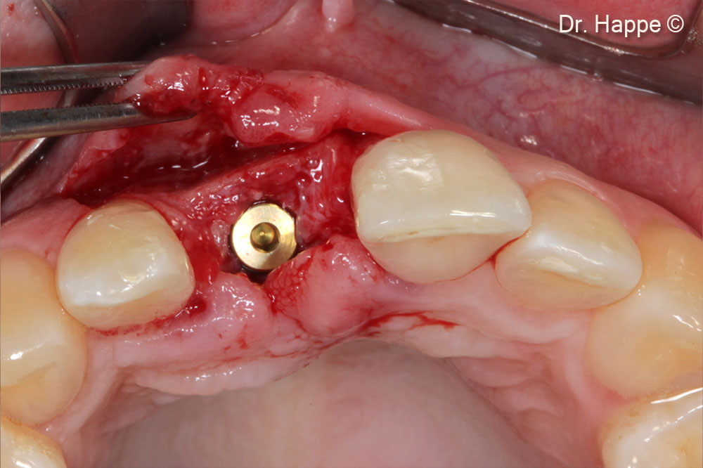 Đã cấy ghép implant đường kính 3.8mm.  Sẵn sàng qua quá trình lành thương qua niêm mạc