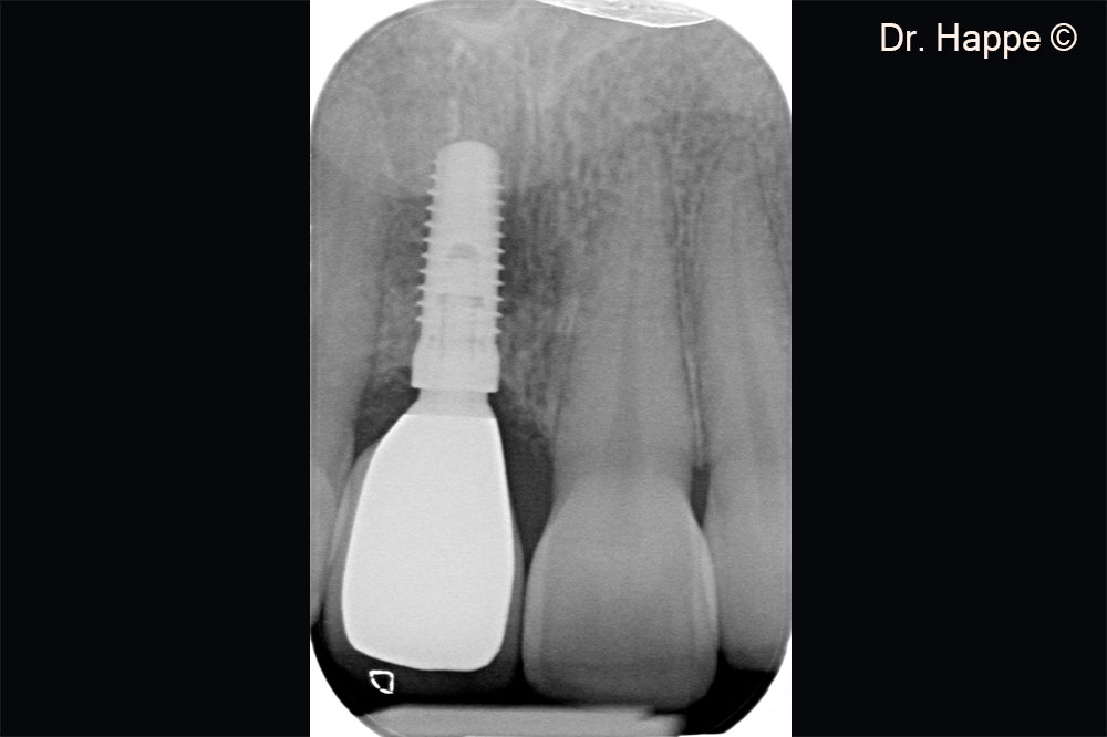 Hình ảnh X-Quang quanh chóp của phục hình cuối cùng