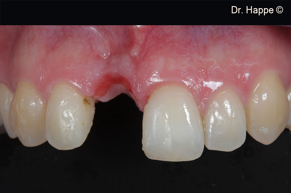 Tình trạng lâm sàn ban đầu, mất răng cửa giữa bên phải. Sau chấn thương thời thơ ấu, răng bị giữ lại và tiêu xương ngoài