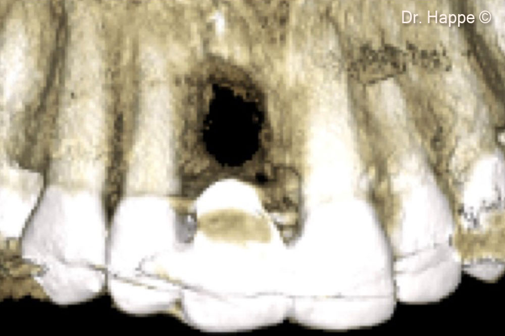 Một phần của Lamina được cố định ở phía má bằng một vít cố định xương đường kính 1mm