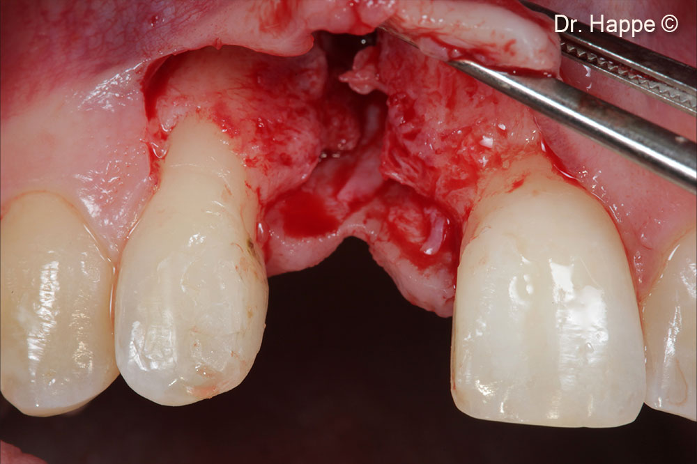 Khoảng trống được tạo ra bởi 2 lớp vỏ dị chủng được lấp đầy bằng các mảnh xương tự thân