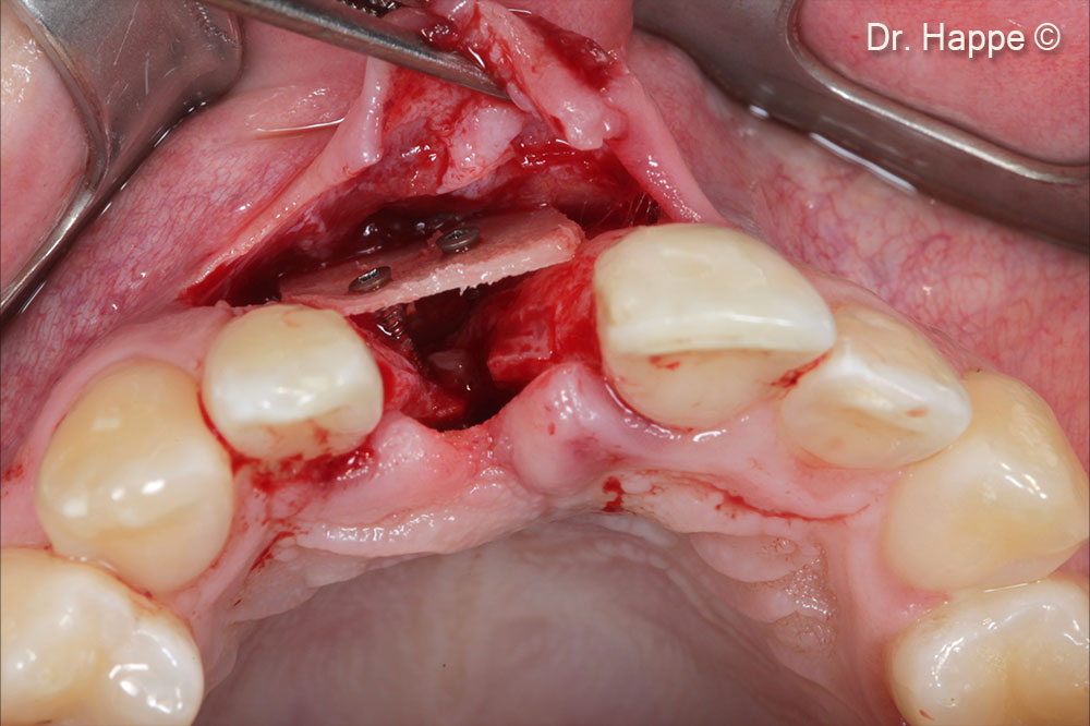 Ảnh chụp màn hình quá trình quét CBST. Khuyết tật loại V với thành vòm miệng bị thiếu