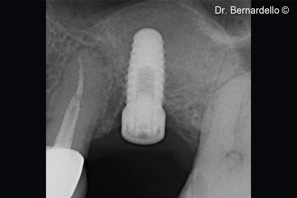 Cấy ghép implant tức thì