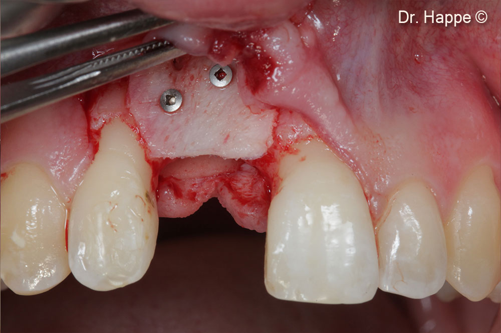 Hình ảnh trong quá trình phẫu thuật cho thấy khuyết tật theo chiều dọc