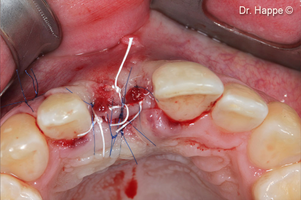 Khâu kín mô mềm một cách tỉ mỉ