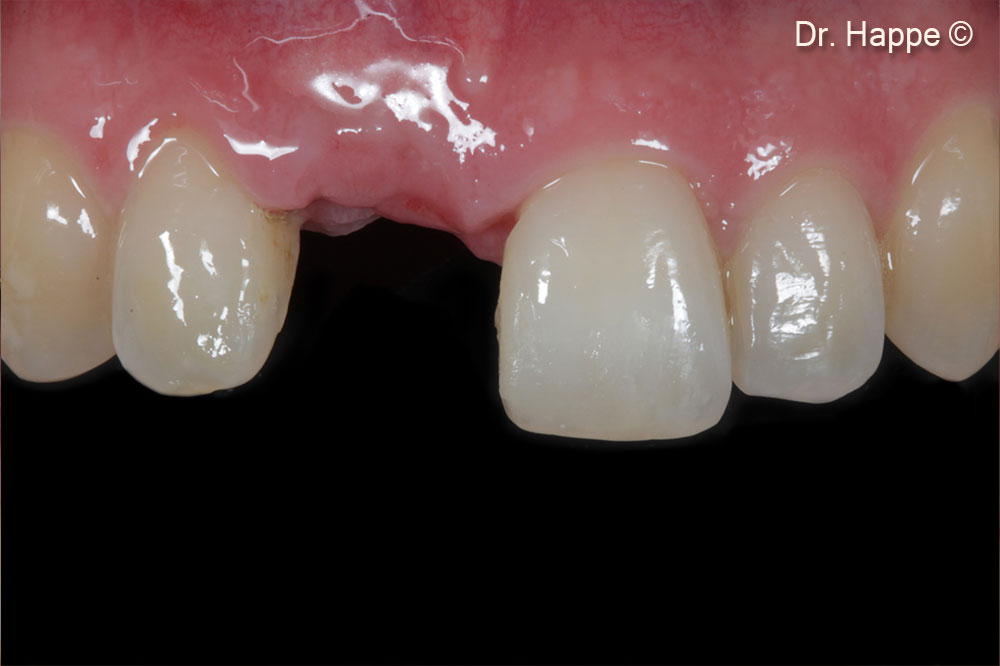 Quá trình lành vết thương sau 4 tháng