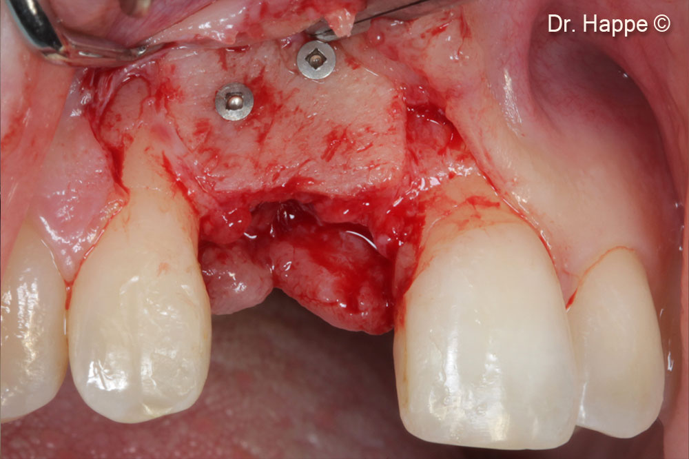 Sự tái tạo sống hàm và sự liền xương của bản xương sau 4 tháng