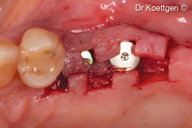 Bóc tách mô bằng kỹ thuật tách ngón tay  tháng sau khi cấy ghép