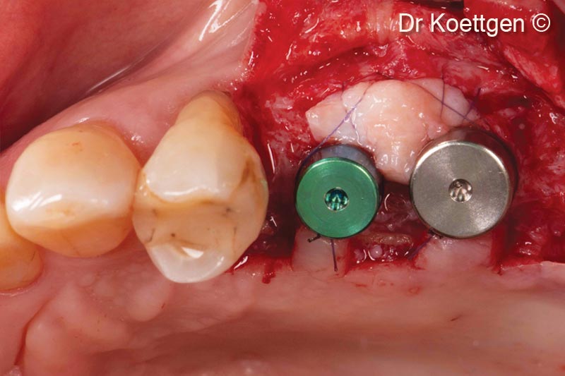 Ghép nướu tự do