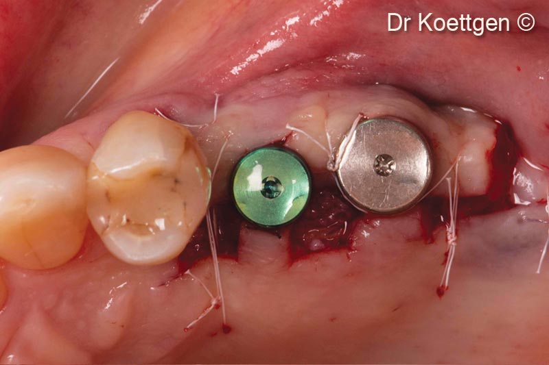 Tình trạng khâu vết thương