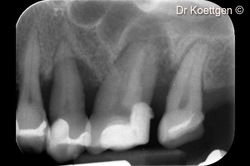 Chụp X-Quang ban đầu