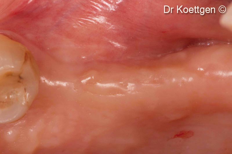 Xương hàm đã lành nhưng bị mất mô cứng và mô mềm