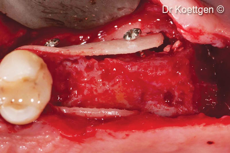 Tạo hình 3D vành má và thành vòm miệng bằng Lamina (0.8mm)