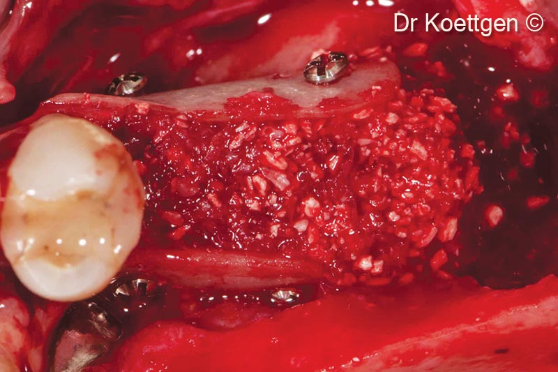 Khuyết tật được lấp đầy bằng xương tự thân trộn với Apatos