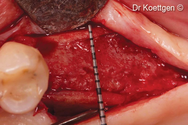 Vết thương lành sau  tháng