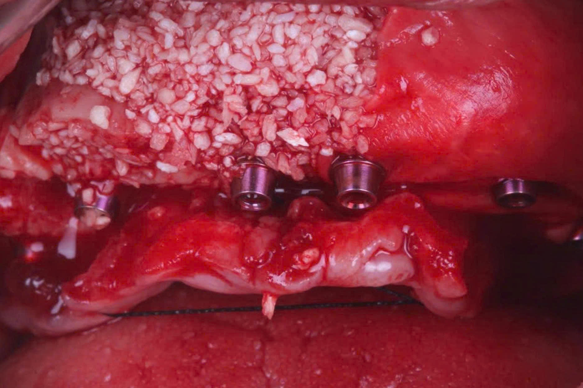 OsteoBiol Apatos (4)