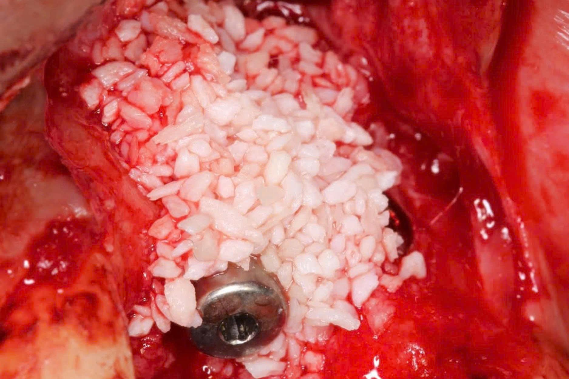 OsteoBiol Apatos (5)