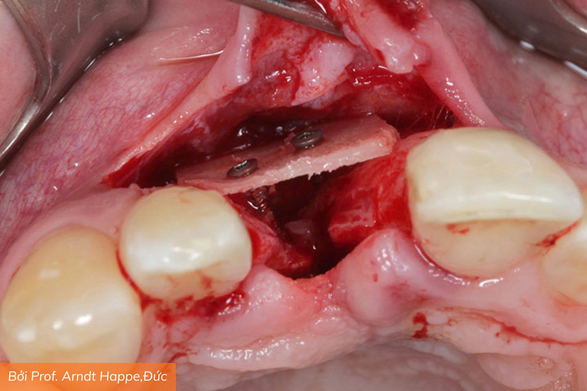 Osteobiol Lamina (3)