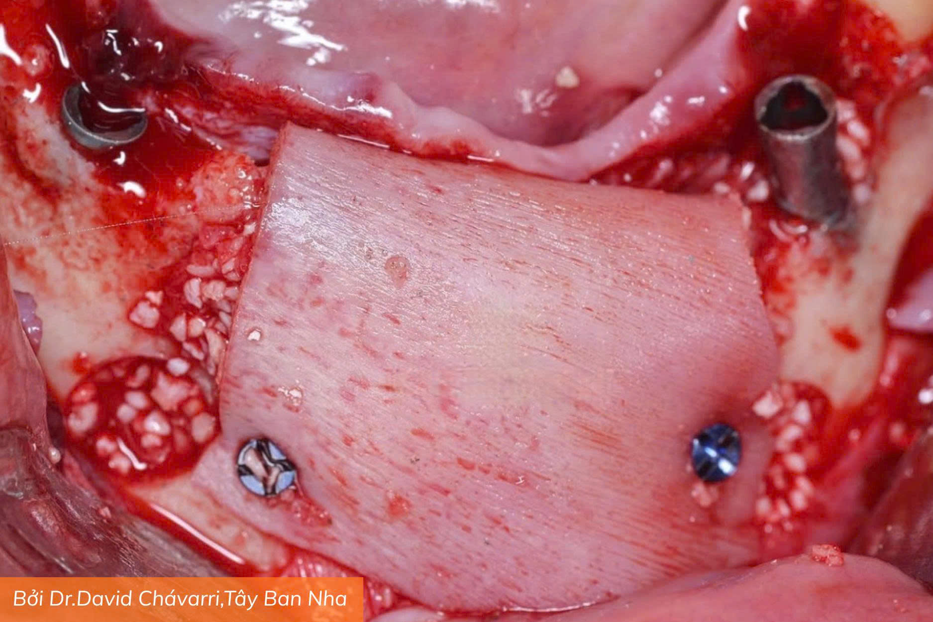 Osteobiol Lamina (5)