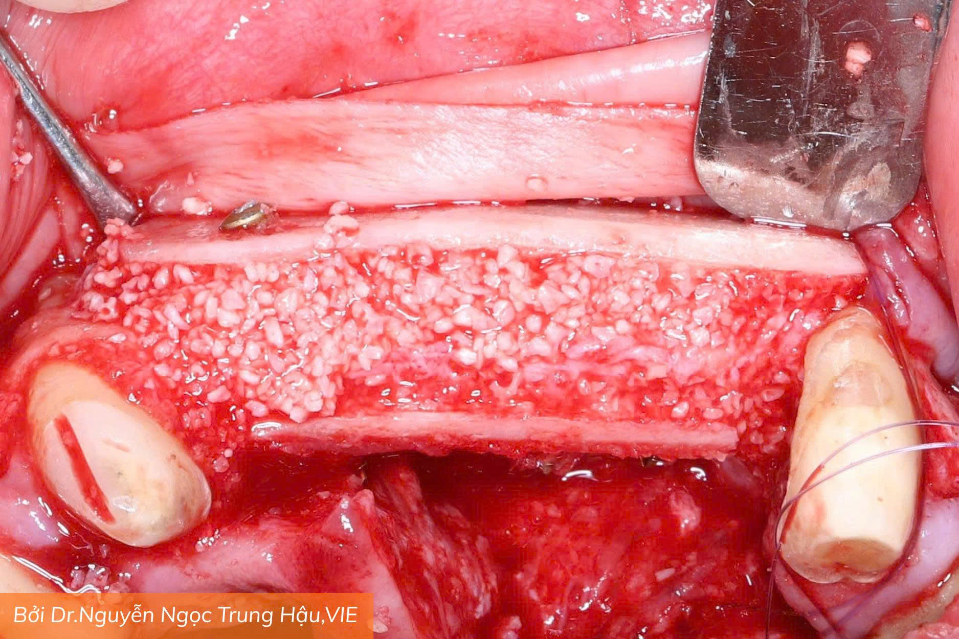 Osteobiol Lamina (6)