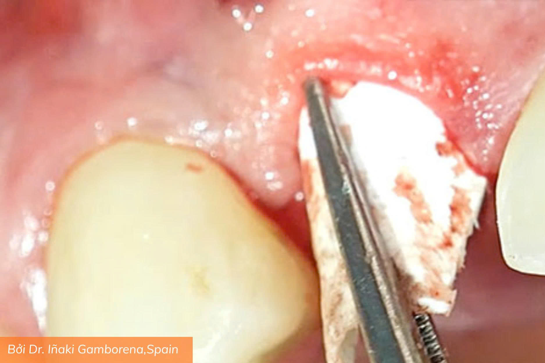 Osteobiol Lamina (9)