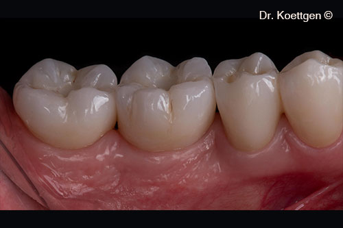 Phục hồi cuối cùng