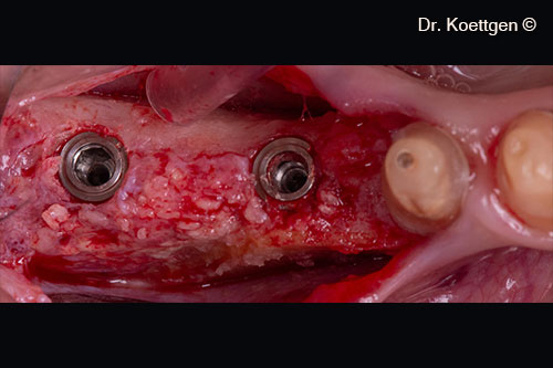 Đặt cấy ghép sau 3 tháng
