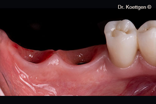 Hình chiếu cạnh