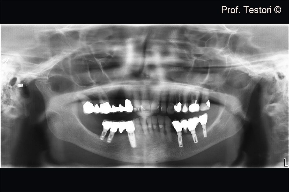 Đánh giá hình ảnh X-Quang trong lần khám tư vấn