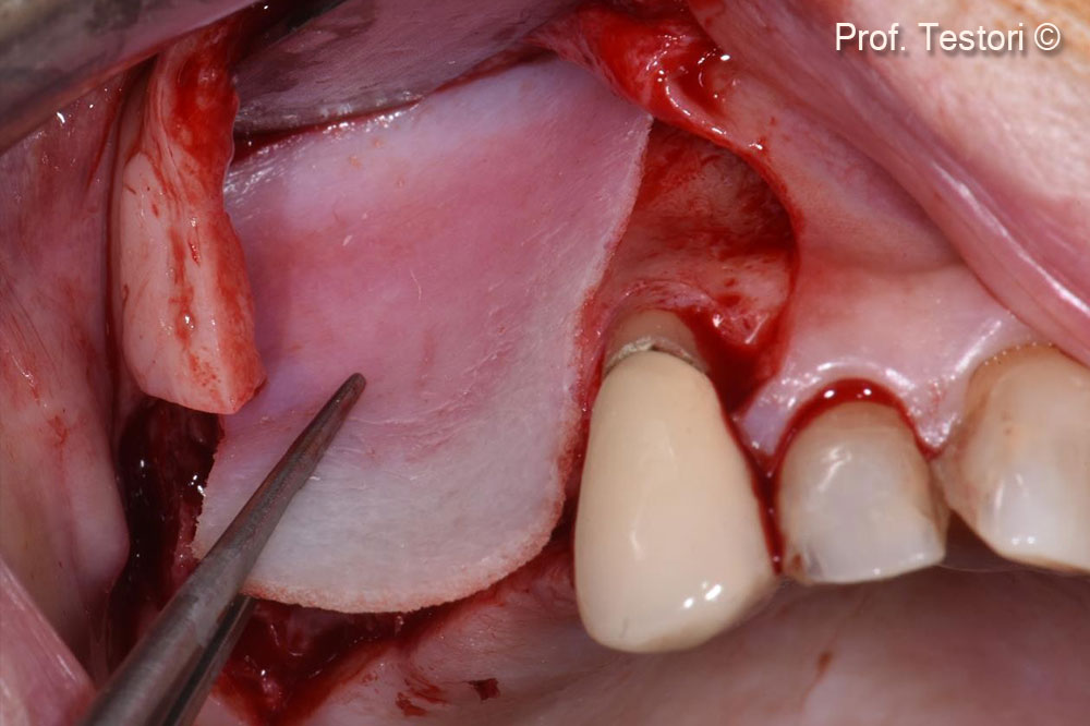 Lamina được thiết kế phù hợp với khuyết tật