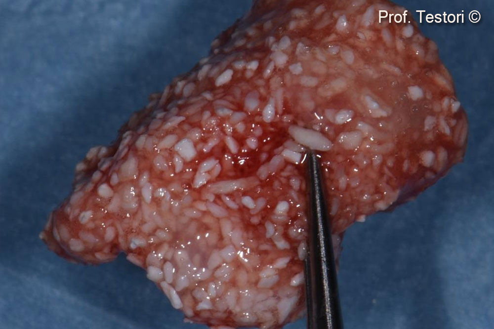 Hỗn hợp Gen-OS, Apatos và chất keo Fibrin