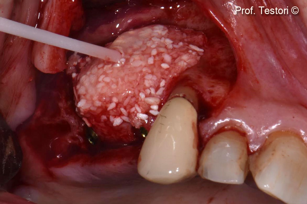 Chất keo fibrin được bôi lên các mảnh xương để tạo điều kiện cho sự bám dính của Lamina