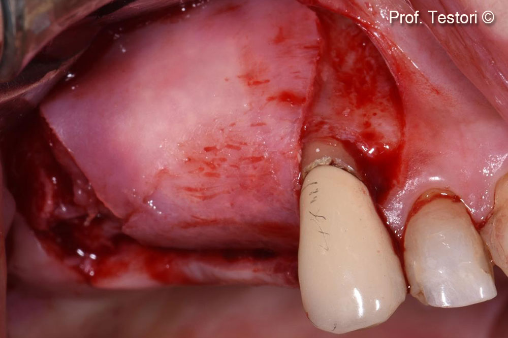 Lemina được đặt vào với lực ấn nhẹh