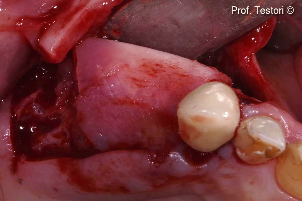 Lemina được đặt vào với lực ấn nhẹh