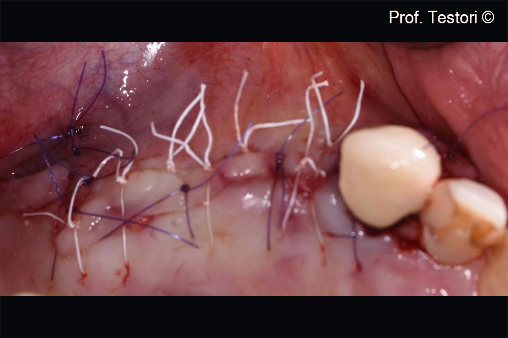 Khâu vạt da sau phẫu thuật tái tạo mô có hướng dẫn (GBR)