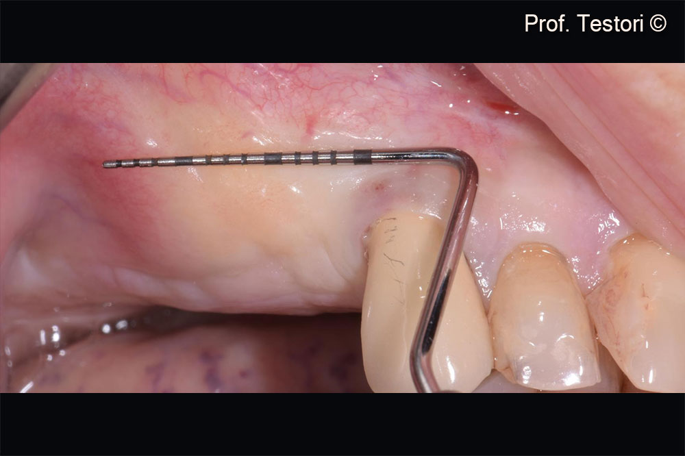 Quá trình lành mô mềm sau 5 tháng.  Vùng được nâng đỡ đang lành lại