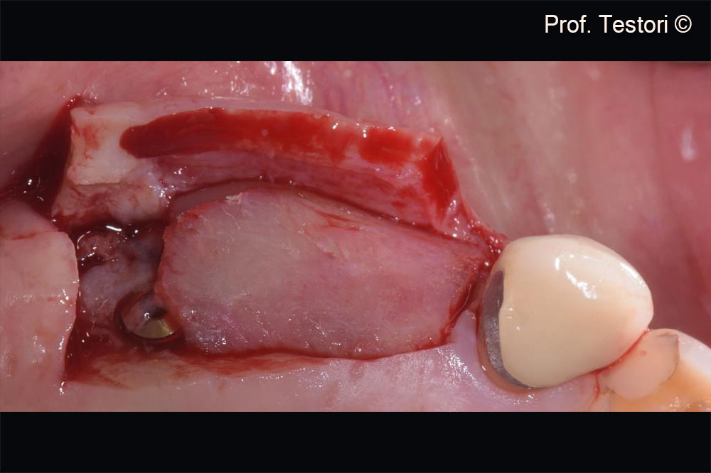 Phẫu thuật giai đoạn 2. Thiết kế vạt da