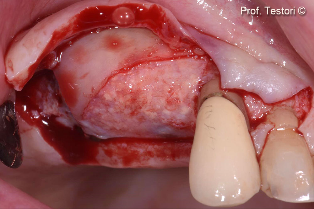 Tái tạo xương sau khi loại bỏ Lamina