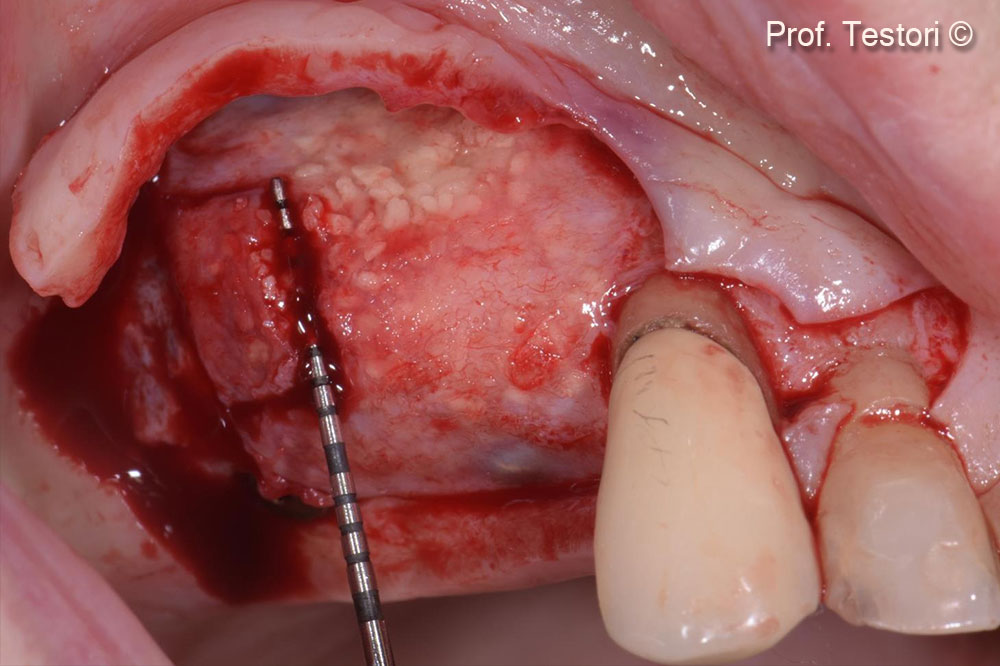 Sinh thiết xương