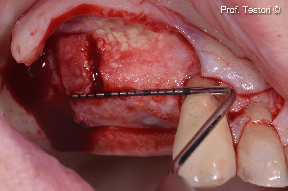 Sinh thiết xương