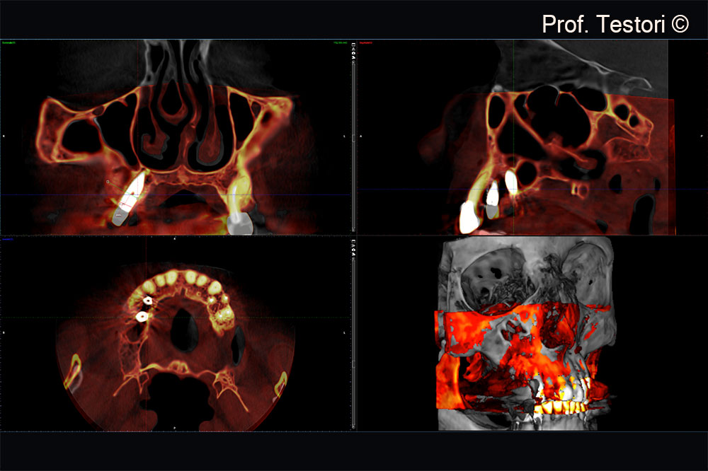 Hình ảnh ba chiều chồng chéo từ ảnh CBCT sau phẫu thuật giai đoạn một (màu xám) và giai đoạn hai (màu đỏ) bằng phần mềm Romasix
