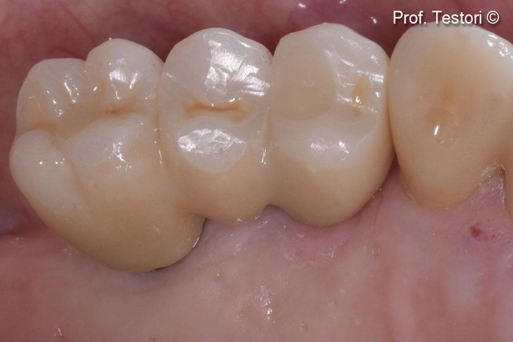 Việc lắp đặt hàm giả hoàn chỉnh được thực hiện qua đường nhìn từ vòm miệng