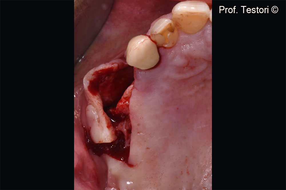 Thiết kế lắp gập