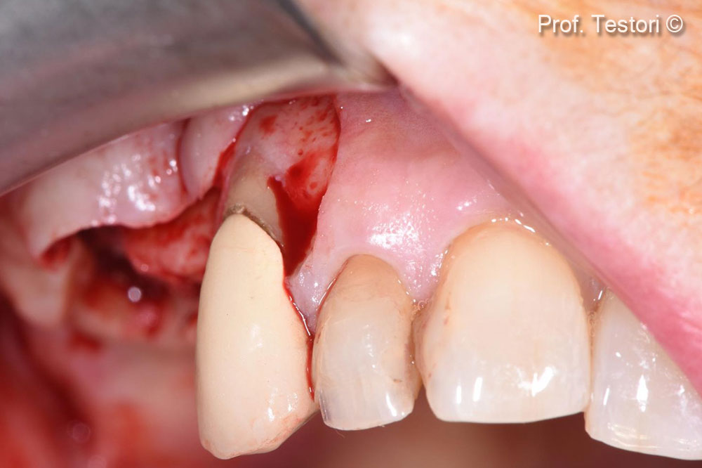 Thiết kế lắp gập