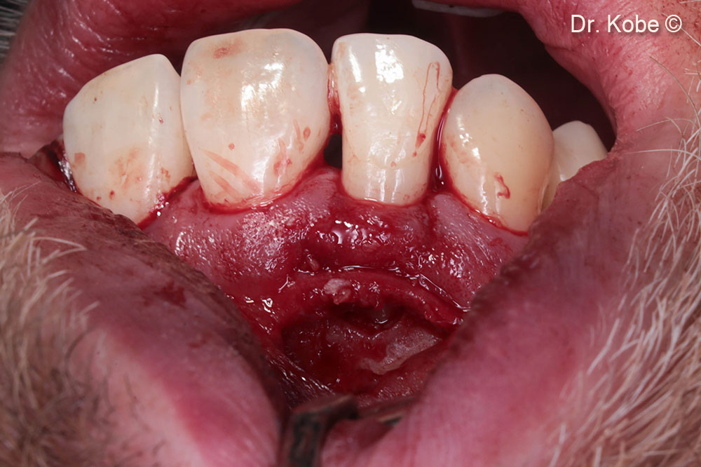 Khuyết tật được lấp đầy bằng Gen-OS