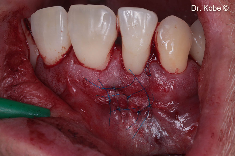 Vết thương được khâu bằng các mũi khâu gián đoạn