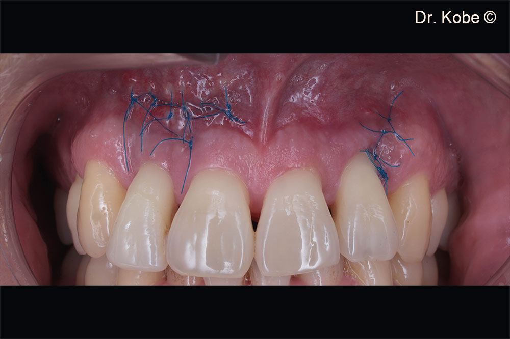 Vết thương lành hoàn toàn