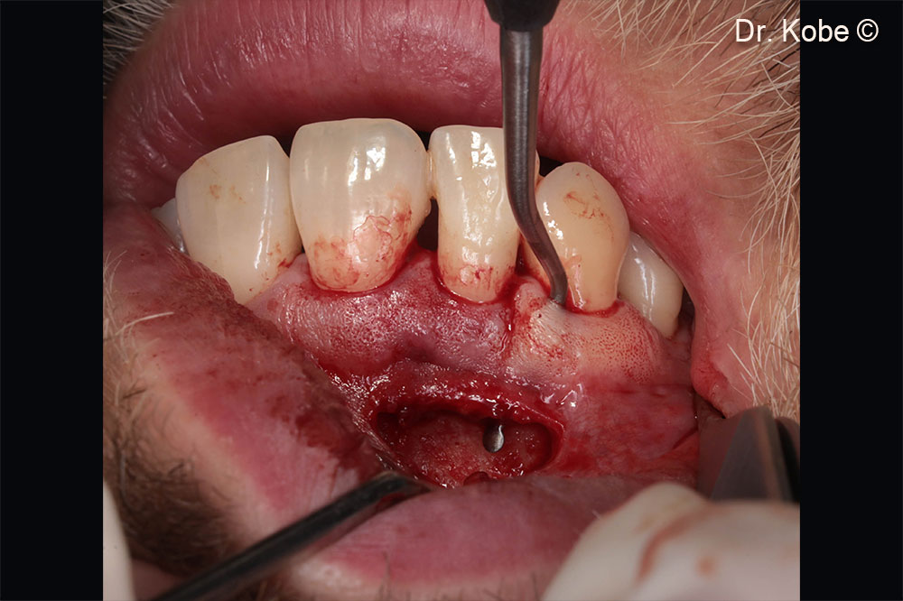 Rạch ngang (NIPSA) ở tiền đình