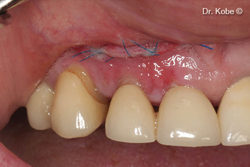 Vết thương lành hoàn toàn sau 1 tuần